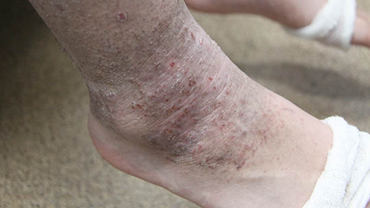 アトピー性皮膚炎