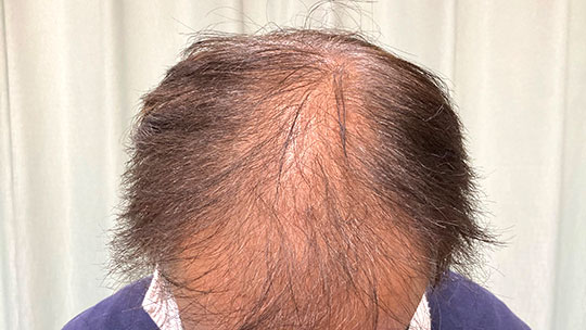 薄毛・抜け毛