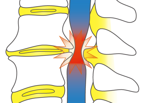 脊柱菅狭窄症の治療