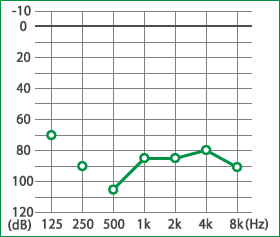 メニエール病：難聴の聴力水平型