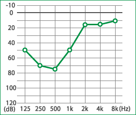 メニエール病：難聴の聴力低音障害型