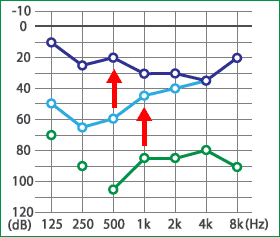 めまい・メニエール病・PPPD