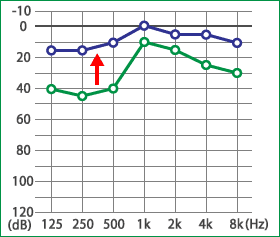 めまい・メニエール病・PPPD