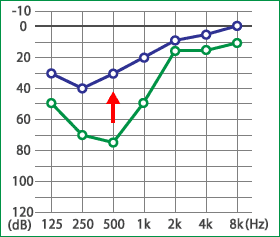 めまい・メニエール病・PPPD