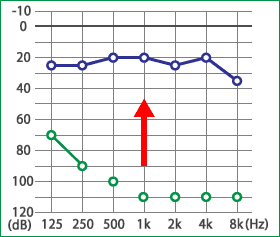 めまい・メニエール病・PPPD