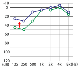 めまい・メニエール病・PPPD