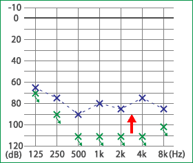 めまい・メニエール病・PPPD