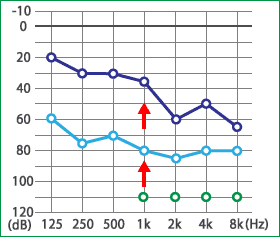 めまい・メニエール病・PPPD