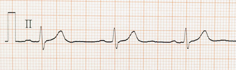 自律神経失調症と心電図