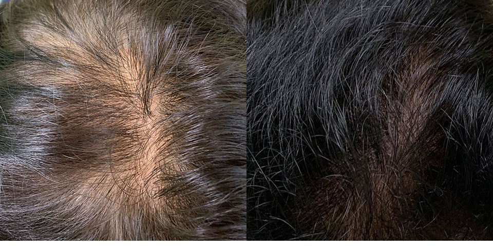 豊田市の薄毛外来